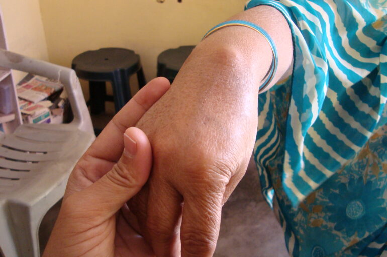 A case of Ganglion in an Old Lady from Balrampur