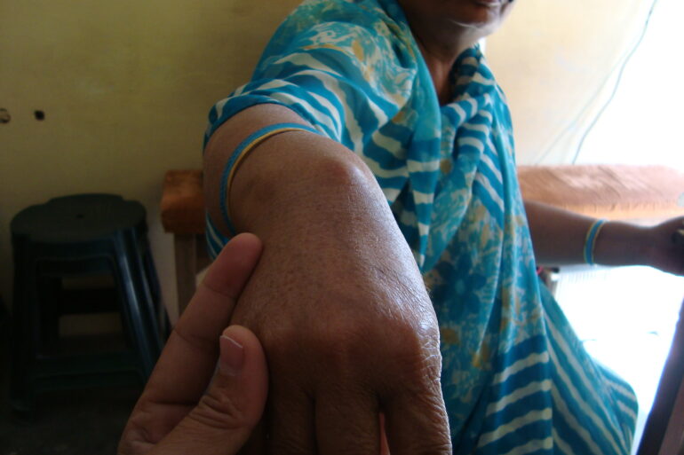 A case of Ganglion in an Old Lady from Balrampur
