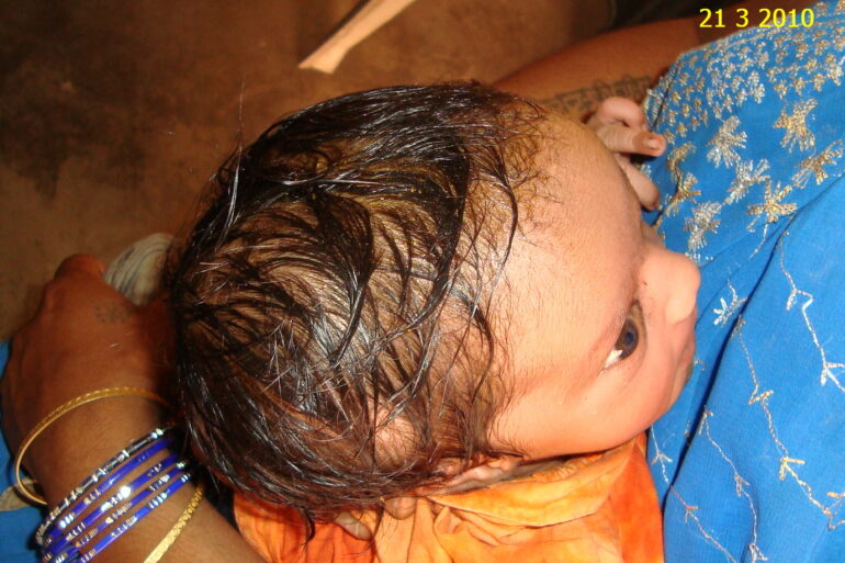A case of Cephalhematoma with 15 years followup
