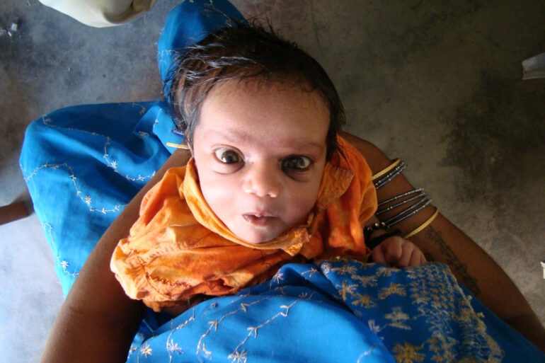 A case of Cephalhematoma with 15 years followup