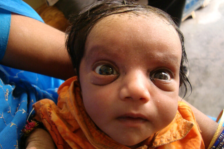 A case of Cephalhematoma with 15 years followup