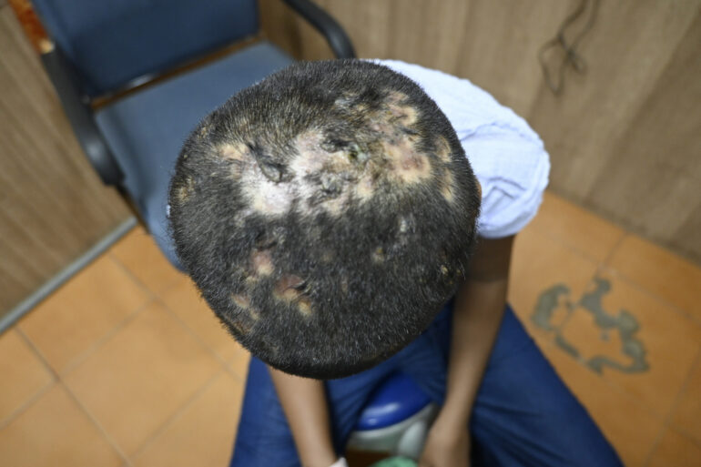 Homeopathy in Scalp Folliculitis: A Case from Raichur, Near Hyderabad