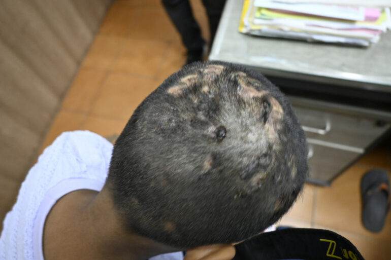 Homeopathy in Scalp Folliculitis: A Case from Raichur, Near Hyderabad