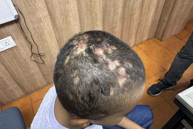 Homeopathy in Scalp Folliculitis: A Case from Raichur, Near Hyderabad