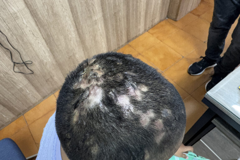 Homeopathy in Scalp Folliculitis: A Case from Raichur, Near Hyderabad