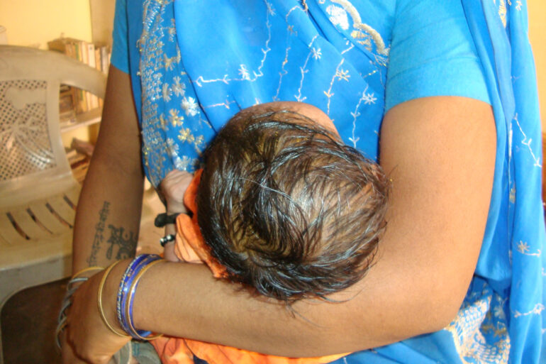A case of Cephalhematoma with 15 years followup