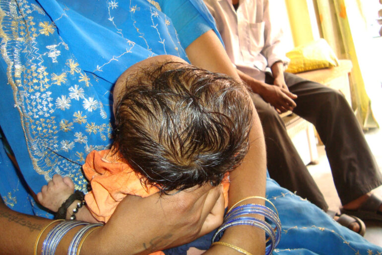 A case of Cephalhematoma with 15 years followup
