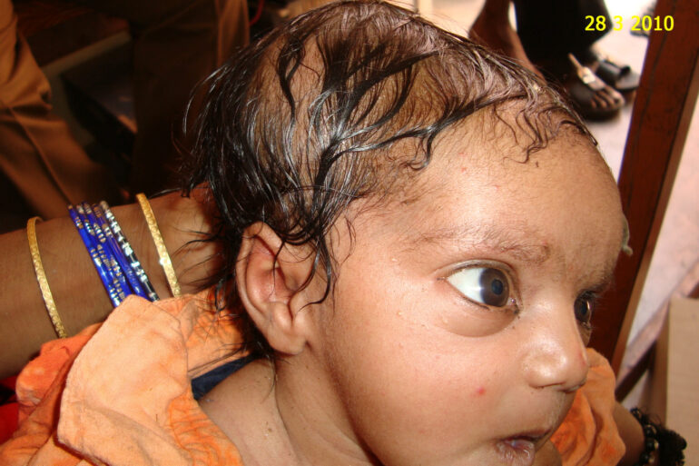 A case of Cephalhematoma with 15 years followup