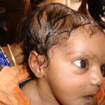 A case of Cephalhematoma with 15 years followup