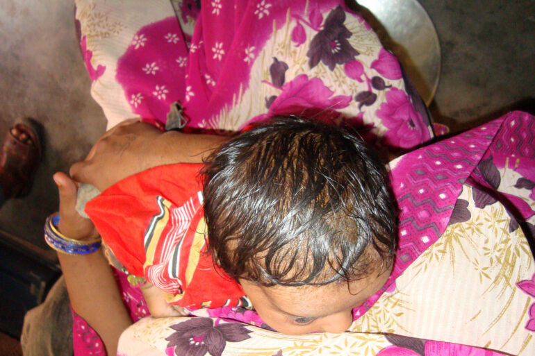 A case of Cephalhematoma with 15 years followup