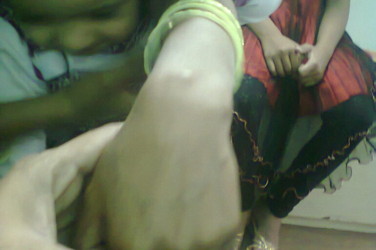 A case of Ganglion at Wrist resolved with Homeopathy