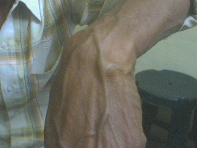 A case of Ganglion at Wrist in a young Man