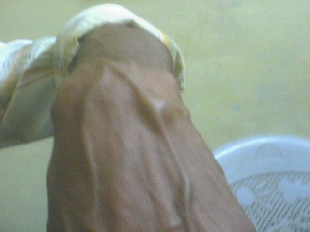 A case of Ganglion at Wrist in a young Man