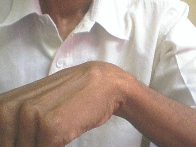 A case of Ganglion at Wrist in a young Man