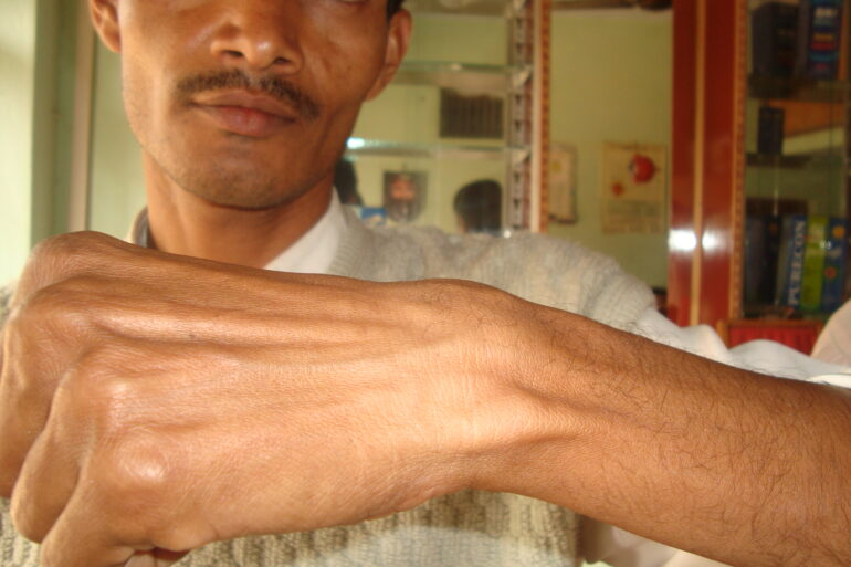 A case of Ganglion at Wrist in a young Man