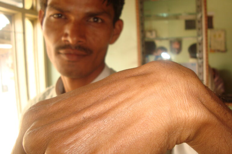 A case of Ganglion at Wrist in a young Man