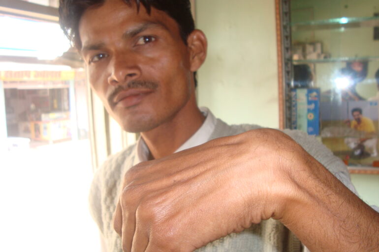 A case of Ganglion at Wrist in a young Man