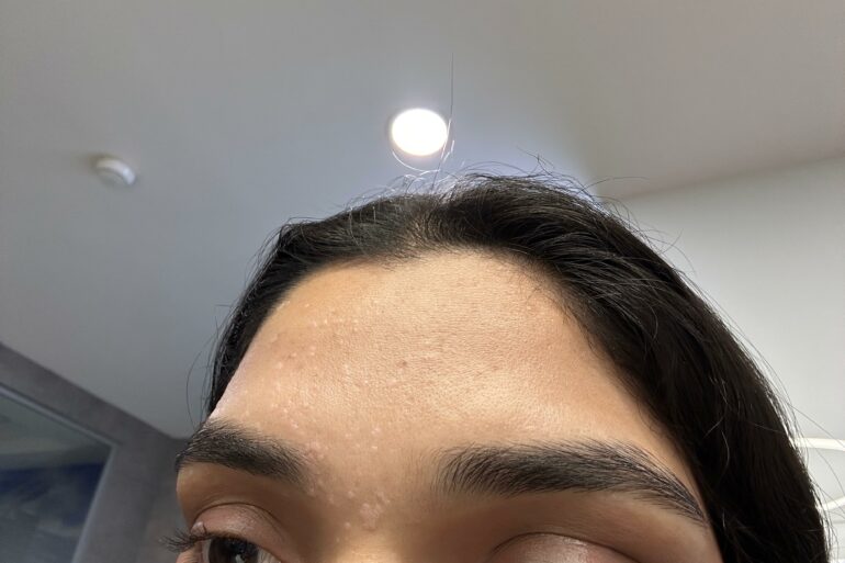 Flat Warts of Verruca Plana for 1 years vanished