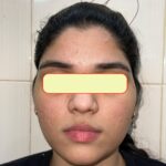Flat Warts of Verruca Plana for 1 years vanished