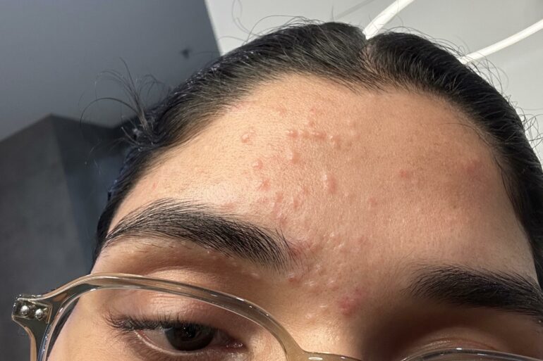 Flat Warts of Verruca Plana for 1 years vanished