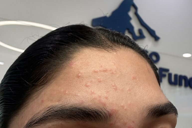 Flat Warts of Verruca Plana for 1 years vanished