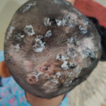 Homeopathy in Scalp Folliculitis: A Case from Raichur, Near Hyderabad