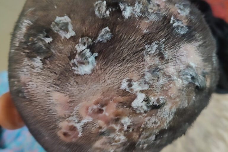 Homeopathy in Scalp Folliculitis: A Case from Raichur, Near Hyderabad
