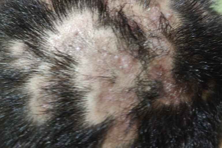 Homeopathy in Scalp Folliculitis: A Case from Raichur, Near Hyderabad