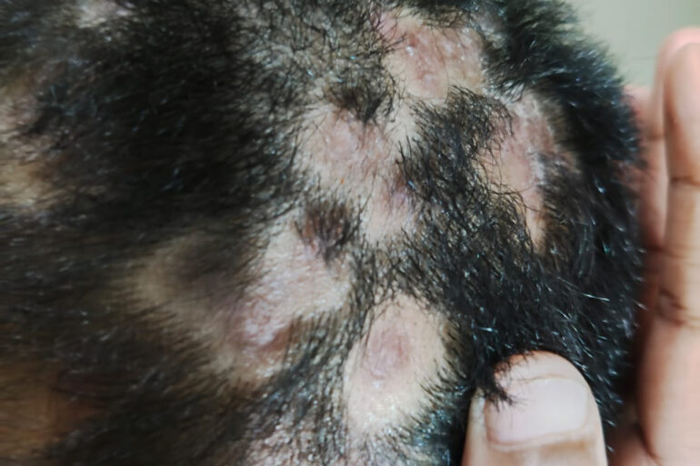 Homeopathy in Scalp Folliculitis: A Case from Raichur, Near Hyderabad