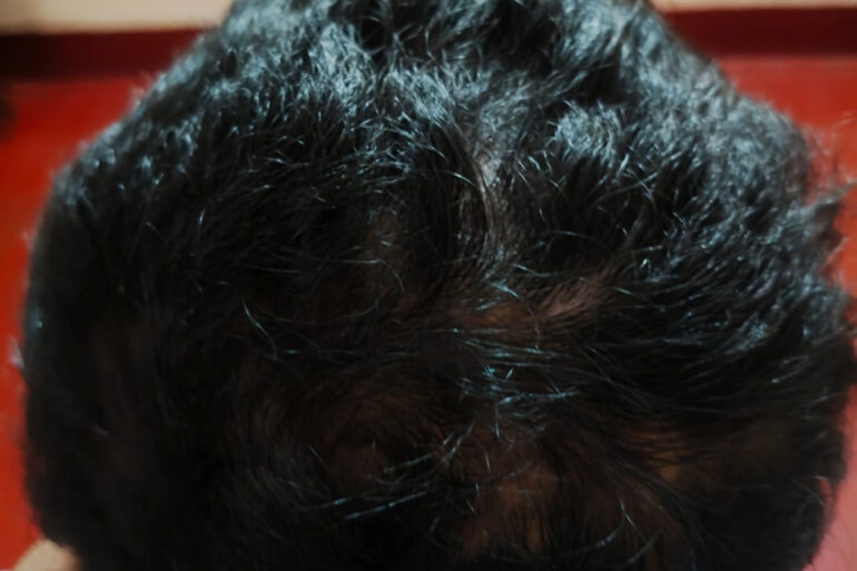 Homeopathy in Scalp Folliculitis: A Case from Raichur, Near Hyderabad