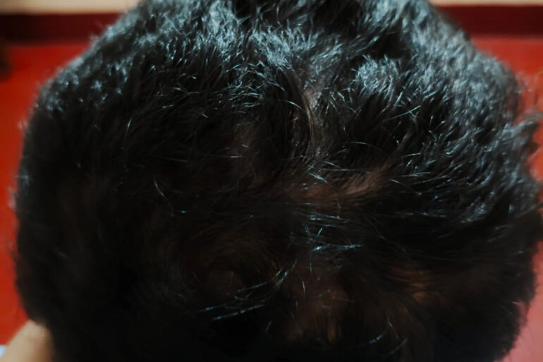 Homeopathy in Scalp Folliculitis: A Case from Raichur, Near Hyderabad