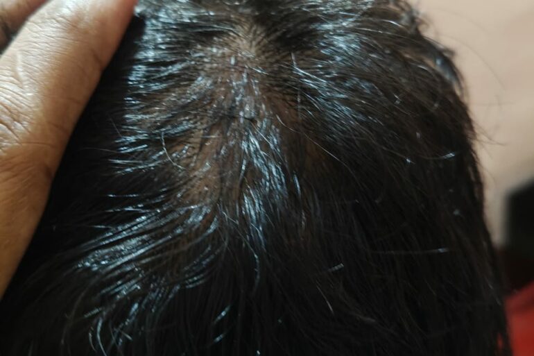 Homeopathy in Scalp Folliculitis: A Case from Raichur, Near Hyderabad