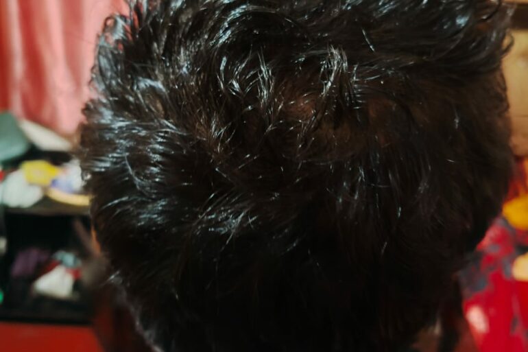 Homeopathy in Scalp Folliculitis: A Case from Raichur, Near Hyderabad