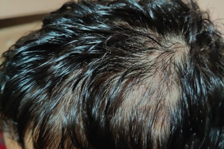 Homeopathy in Scalp Folliculitis: A Case from Raichur, Near Hyderabad