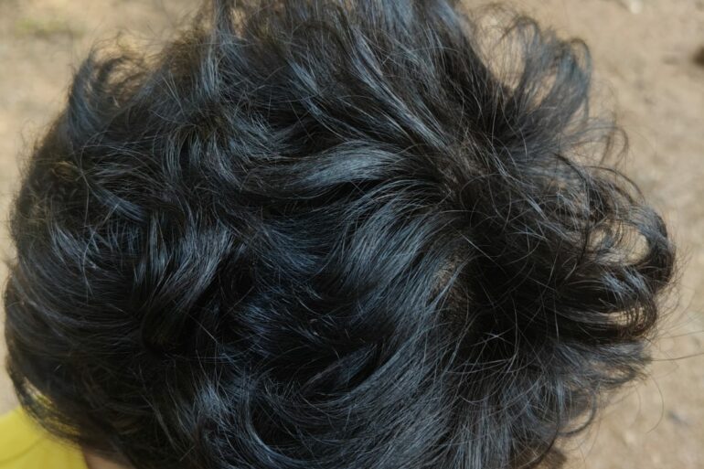 Homeopathy in Scalp Folliculitis: A Case from Raichur, Near Hyderabad