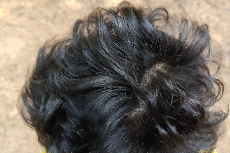 Homeopathy in Scalp Folliculitis: A Case from Raichur, Near Hyderabad