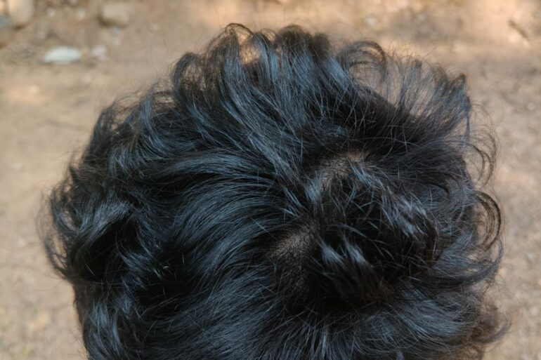 Homeopathy in Scalp Folliculitis: A Case from Raichur, Near Hyderabad