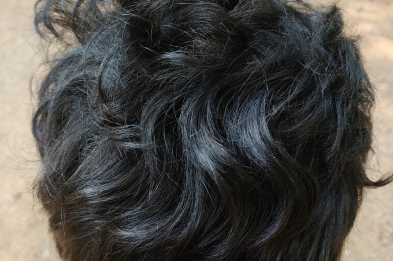 Homeopathy in Scalp Folliculitis: A Case from Raichur, Near Hyderabad