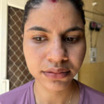 A young constable from Meerut, Uttar Pradesh, suffered from ugly flat warts got cured miraculously