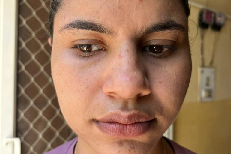 A young constable from Meerut, Uttar Pradesh, suffered from ugly flat warts got cured miraculously
