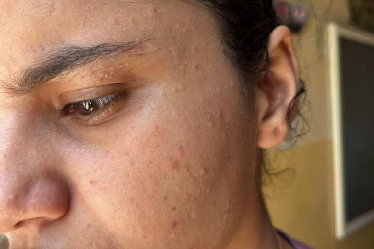 A young constable from Meerut, Uttar Pradesh, suffered from ugly flat warts got cured miraculously