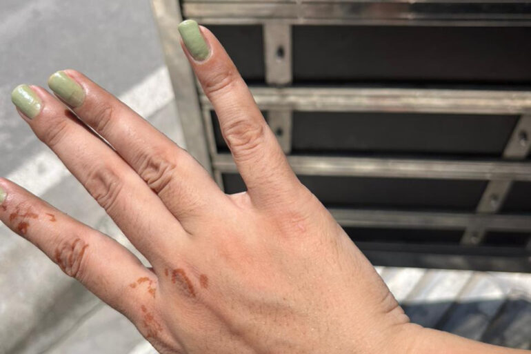 A young constable from Meerut, Uttar Pradesh, suffered from ugly flat warts got cured miraculously