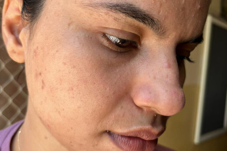 A young constable from Meerut, Uttar Pradesh, suffered from ugly flat warts got cured miraculously
