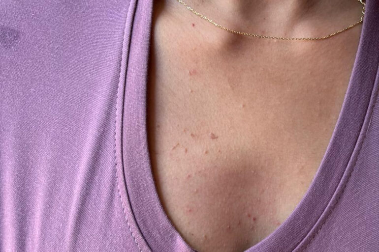 A young constable from Meerut, Uttar Pradesh, suffered from ugly flat warts got cured miraculously