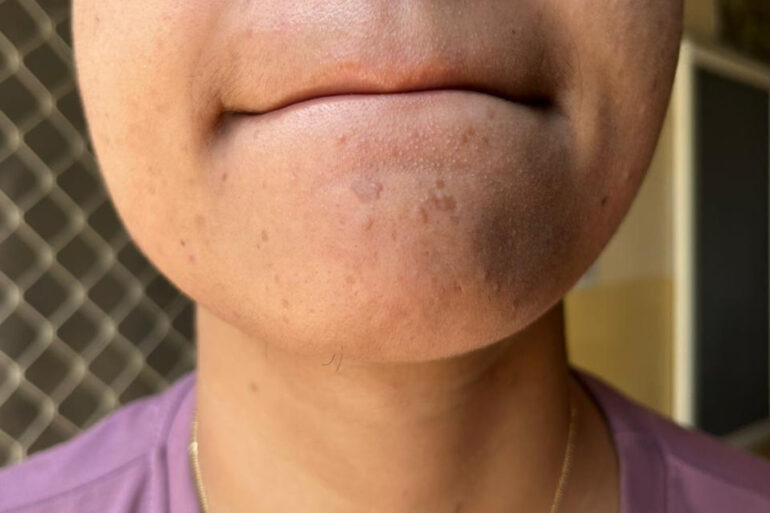 A young constable from Meerut, Uttar Pradesh, suffered from ugly flat warts got cured miraculously
