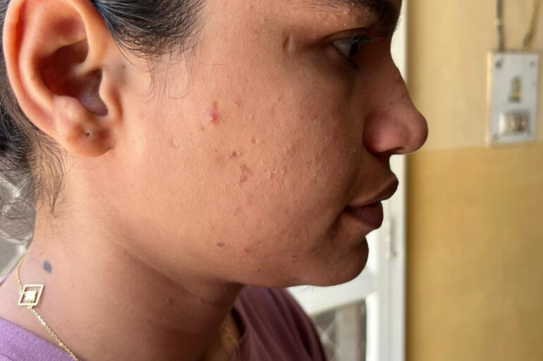 A young constable from Meerut, Uttar Pradesh, suffered from ugly flat warts got cured miraculously