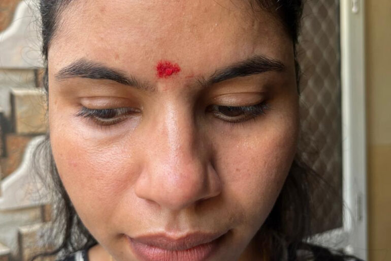 A young constable from Meerut, Uttar Pradesh, suffered from ugly flat warts got cured miraculously