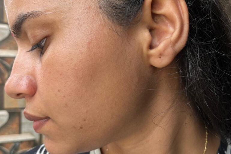 A young constable from Meerut, Uttar Pradesh, suffered from ugly flat warts got cured miraculously