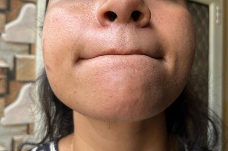 A young constable from Meerut, Uttar Pradesh, suffered from ugly flat warts got cured miraculously