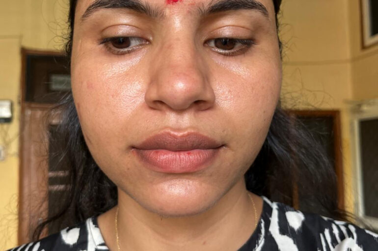 A young constable from Meerut, Uttar Pradesh, suffered from ugly flat warts got cured miraculously